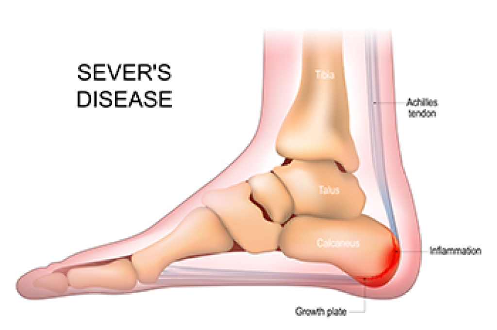 Child holding a sore heel after activity