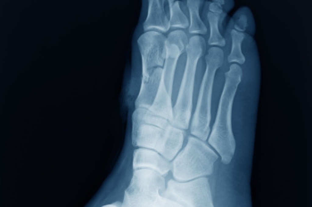 Hand pressing the outer side of a painful foot