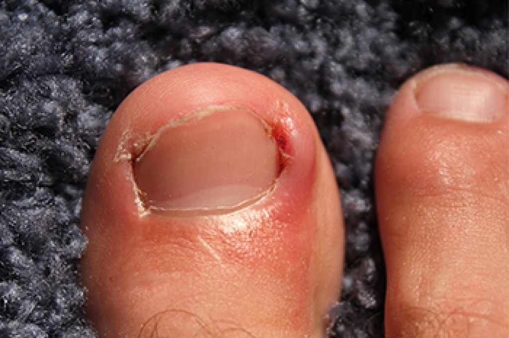 Red, swollen skin beside an ingrown big toenail