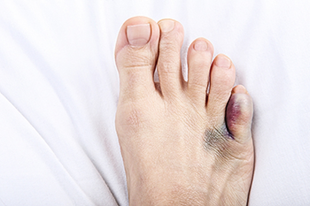 Close-up of a swollen little toe