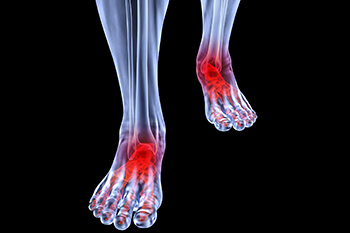 Arthritic foot and ankle care treatment in the Fleming Island, FL 32003 and Palm Coast, FL 32137 area