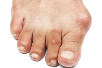 Bunions treatment in Fleming Island, FL & Palm Coast, FL