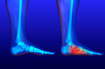 Flat Feet Treatment in Fleming Island, FL and Palm Coast, FL