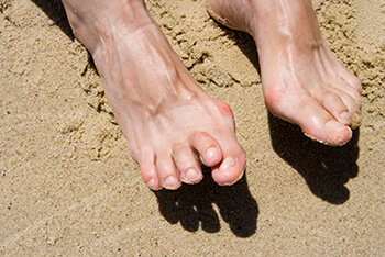 Hammertoes specialist in Fleming Island, FL & Palm Coast, FL