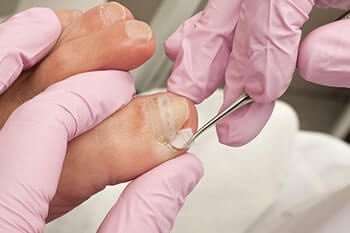 ingrown toenail in the Fleming Island, FL 32003 and Palm Coast, FL 32137 area