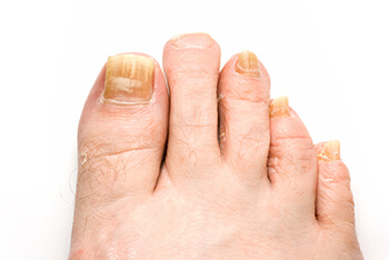 toenail fungus treatment in Fleming Island, FL and Palm Coast, FL