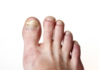 Is There a Connection Between Poor Circulation and Toenail Fungus?