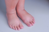 Lymphoedema and Swelling of the Feet