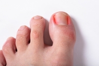 When Ingrown Toenails Become More Than a Minor Nuisance