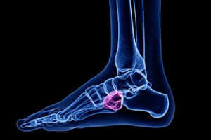 The Painful Symptoms of Cuboid Syndrome