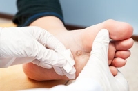 The Two Types of Plantar Warts