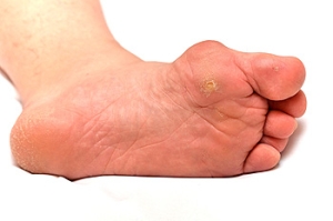 Corns and Calluses Are Different