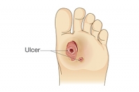 Foot Ulcers and Diabetic Patients