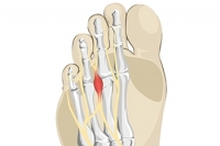 What Is a Neuroma?